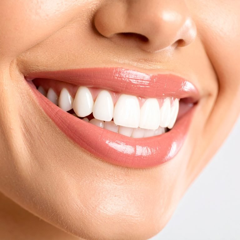 Firefly_Blanchiment des dents 686370